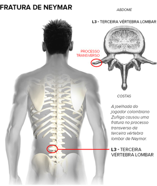 Illustration for article titled Report: Neymar Would Try To Play If Brazil Made World Cup Final